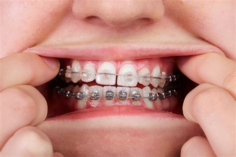 metal bracket orthodontic|metal braces with clear bands.